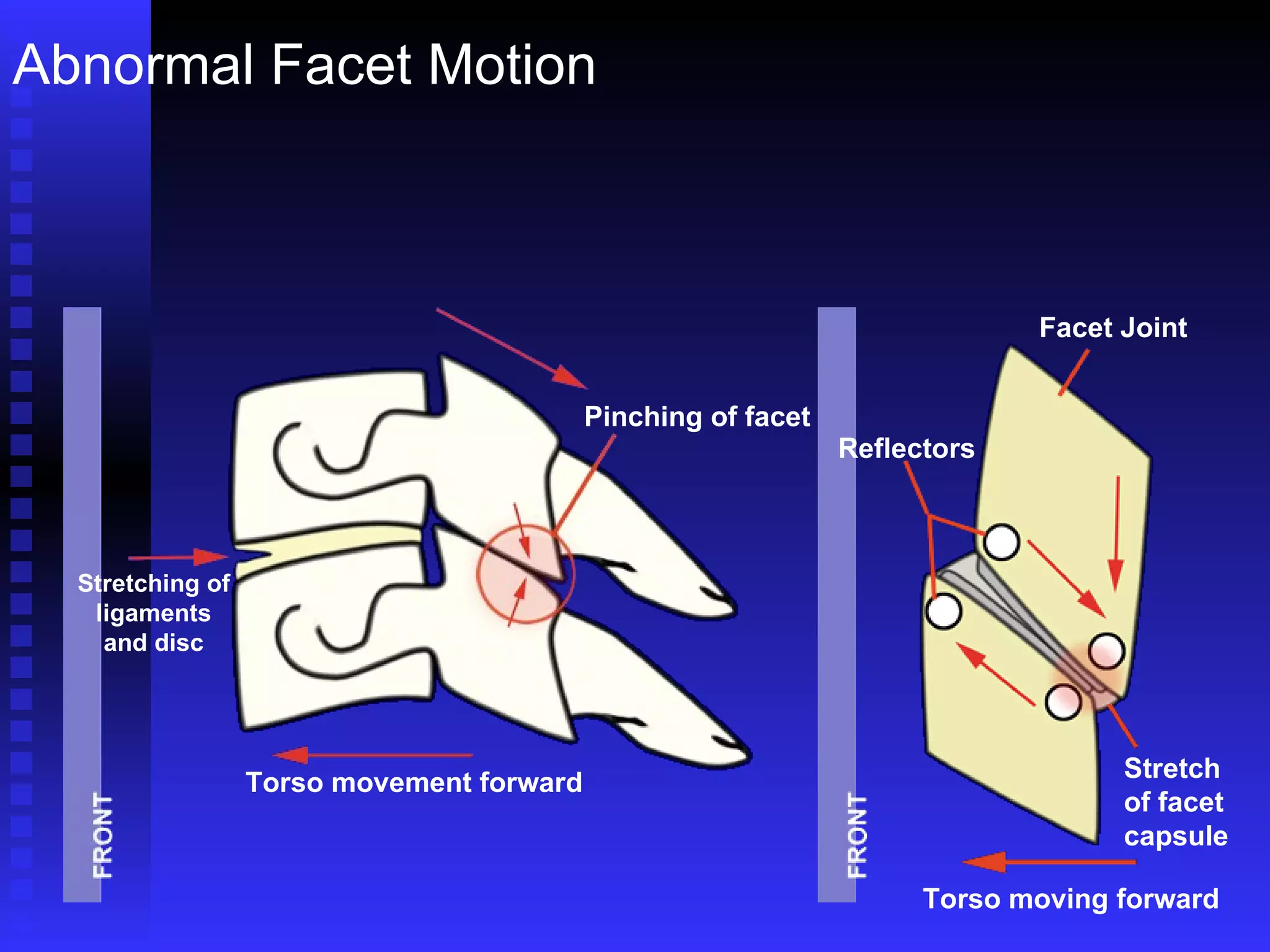 Abnormal Facet Motion Pinching of facet Torso movement forward Torso moving forward Stretching of ligaments and disc Facet Joint Reflectors Stretch of facet capsule 