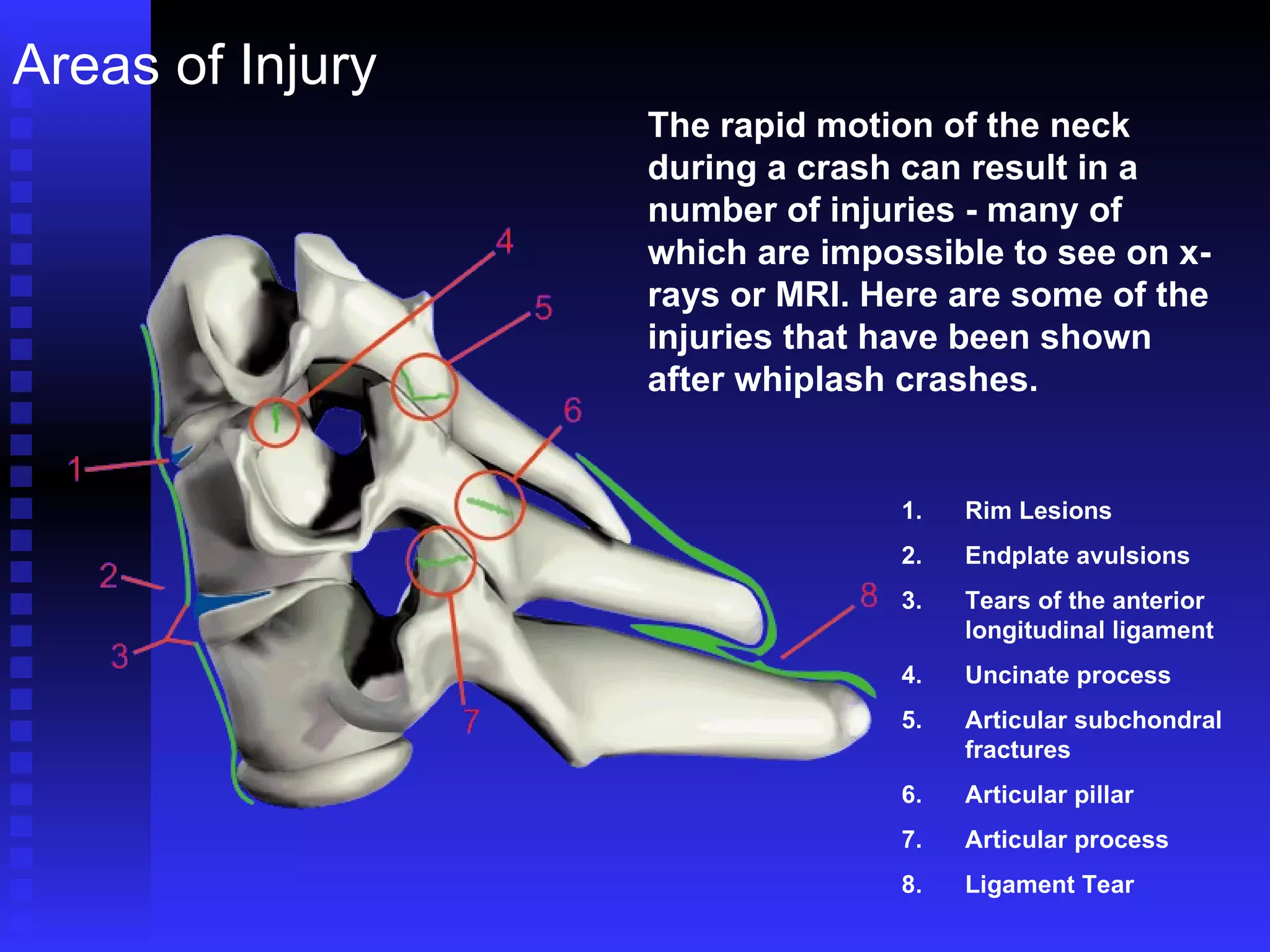 Areas of Injury The rapid motion of the neck during a crash can result in a number of injuries - many of which are impossible to see on x-rays or MRI. Here are some of the injuries that have been shown after whiplash crashes. Rim Lesions Endplate avulsions Tears of the anterior longitudinal ligament Uncinate process Articular subchondral fractures  Articular pillar Articular process Ligament Tear 