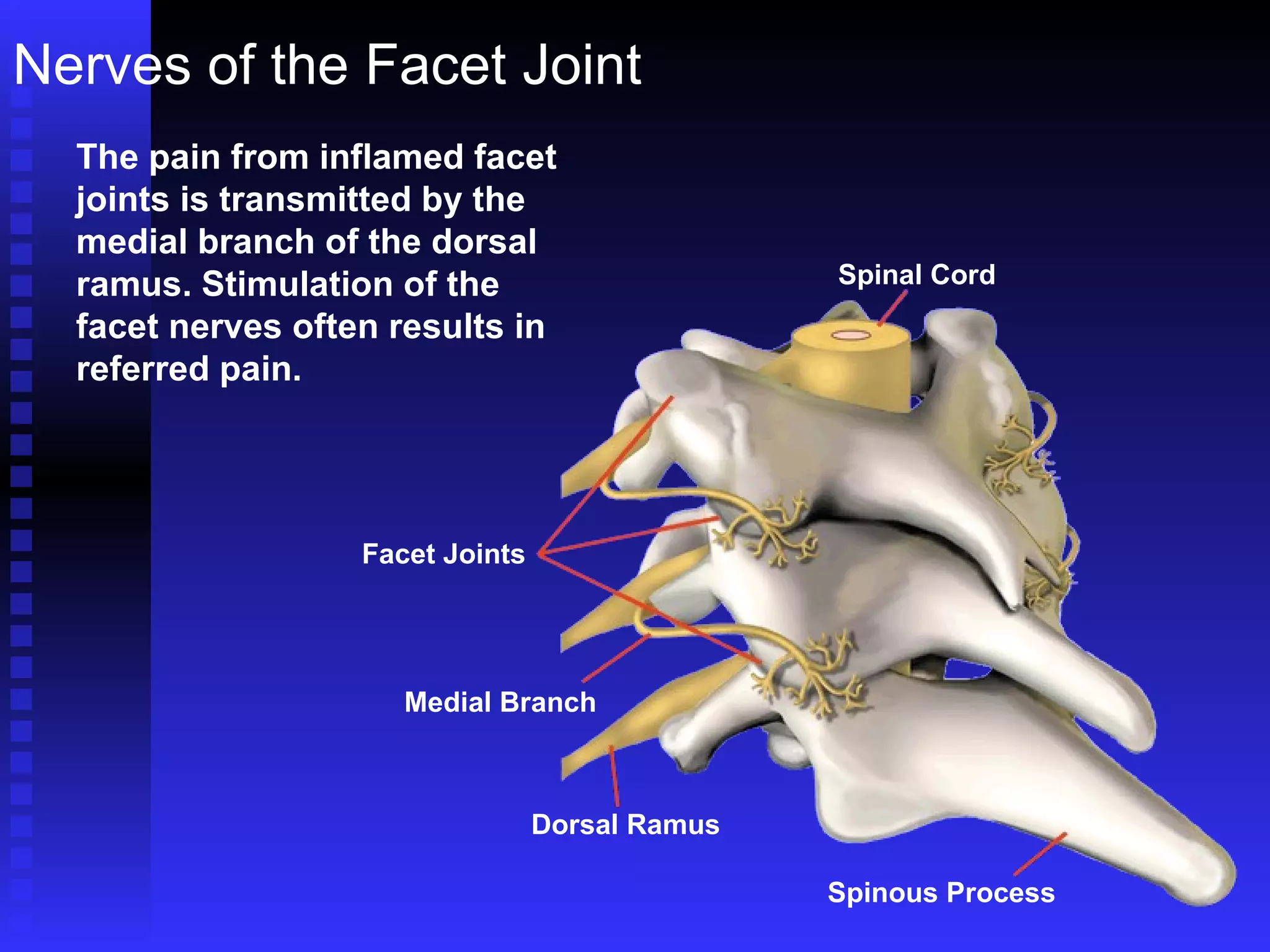 Nerves of the Facet Joint The pain from inflamed facet joints is transmitted by the medial branch of the dorsal ramus. Stimulation of the facet nerves often results in referred pain. Facet Joints Medial Branch Dorsal Ramus Spinous Process Spinal Cord 