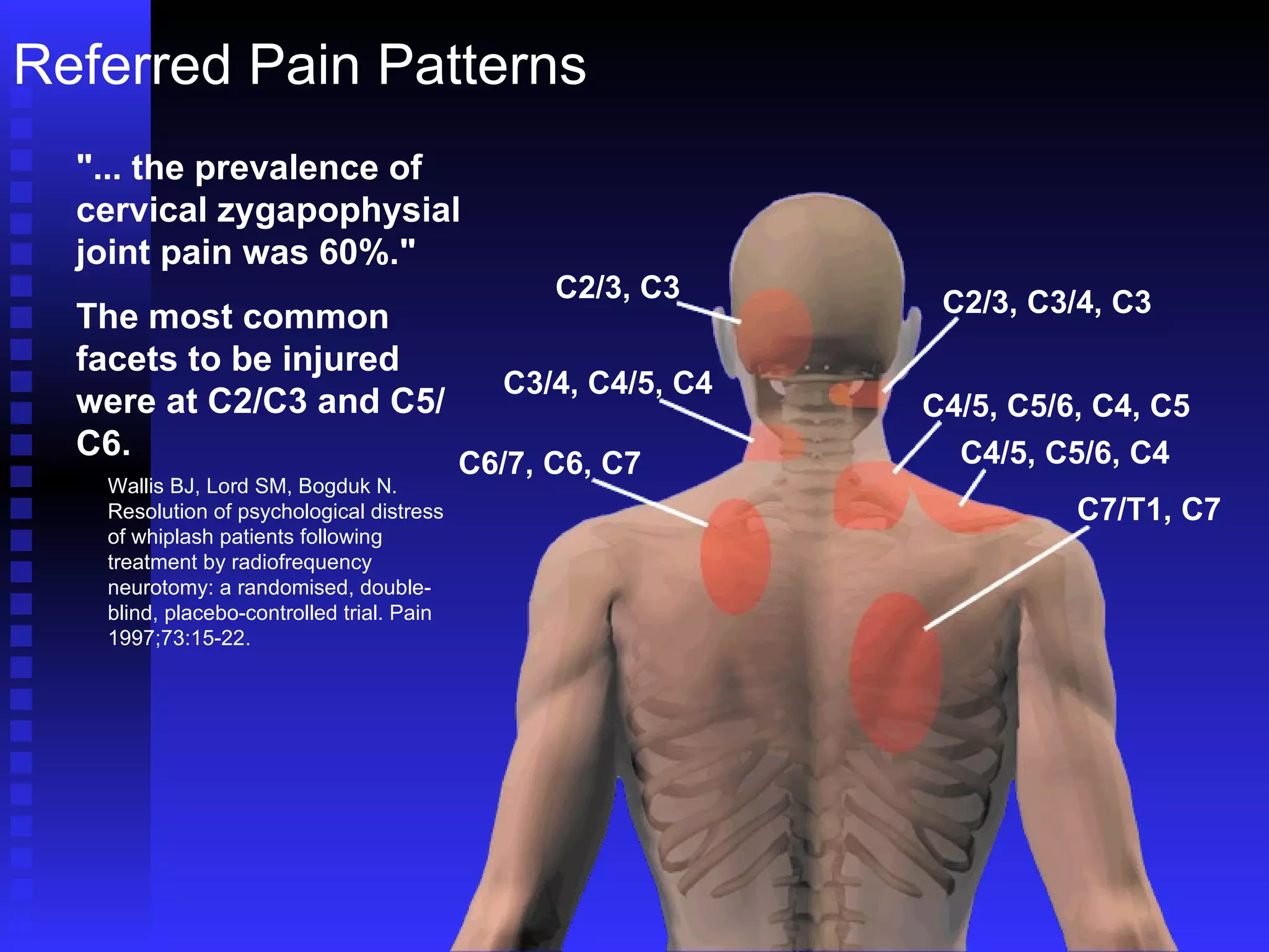 Referred Pain Patterns "... the prevalence of cervical zygapophysial joint pain was 60%." The most common facets to be injured were at C2/C3 and C5/C6. Wallis BJ, Lord SM, Bogduk N. Resolution of psychological distress of whiplash patients following treatment by radiofrequency neurotomy: a randomised, double-blind, placebo-controlled trial. Pain 1997;73:15-22. C2/3, C3 C3/4, C4/5, C4 C6/7, C6, C7 C2/3, C3/4, C3 C4/5, C5/6, C4, C5 C4/5, C5/6, C4 C7/T1, C7 