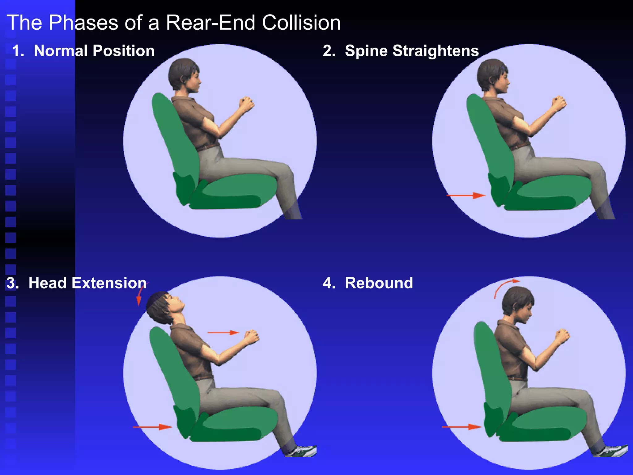 The Phases of a Rear-End Collision 1.  Normal Position 2.  Spine Straightens 3.  Head Extension 4.  Rebound 