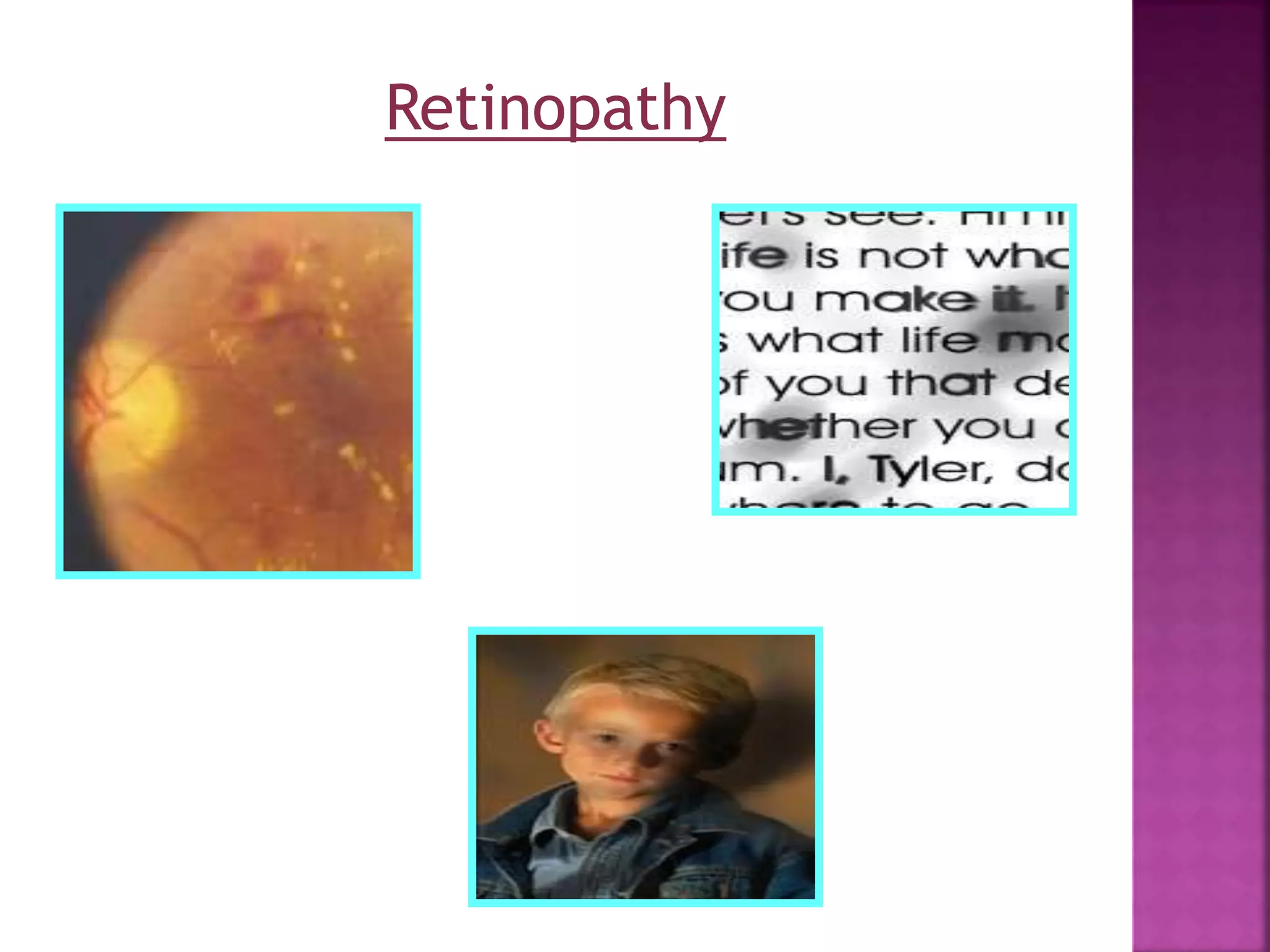 Retinopathy
 