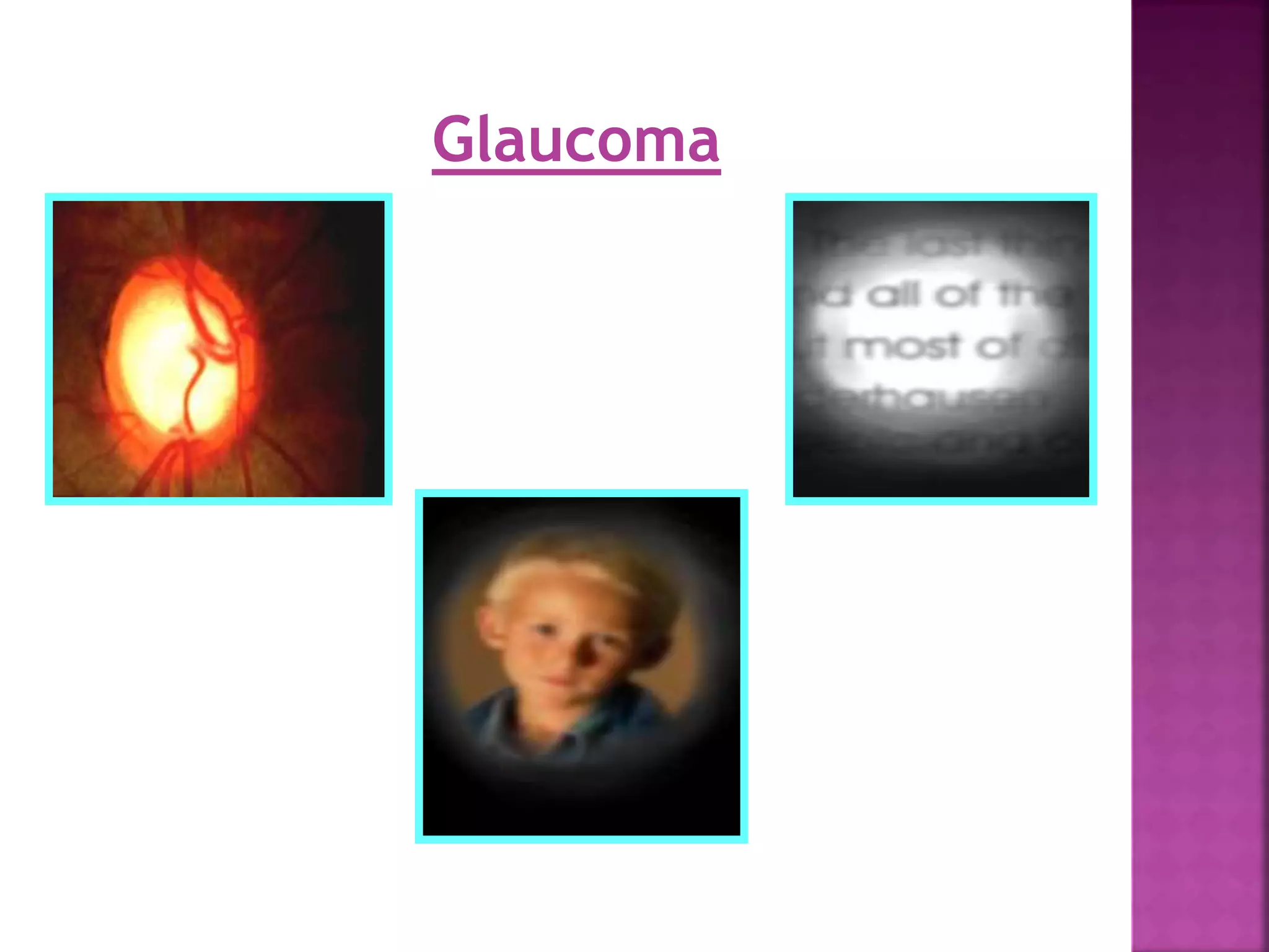 Glaucoma
 