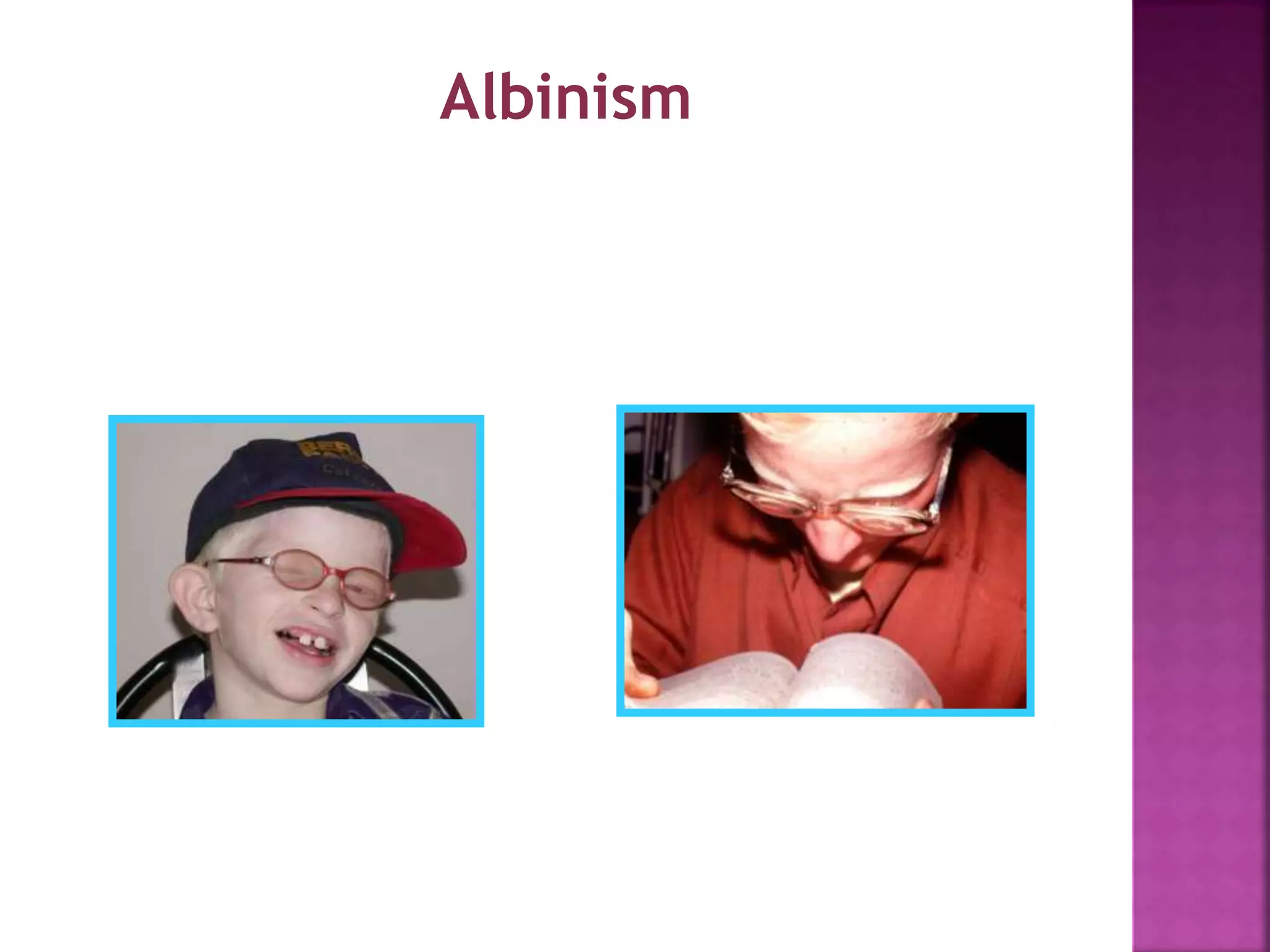 Albinism
 