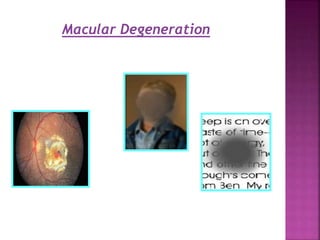 Macular Degeneration
 