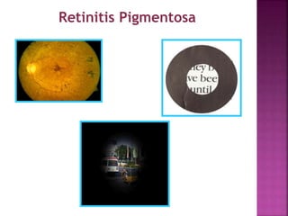 Retinitis Pigmentosa
 