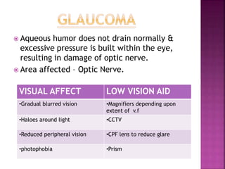  Aqueous humor does not drain normally &
excessive pressure is built within the eye,
resulting in damage of optic nerve.
 Area affected – Optic Nerve.
VISUAL AFFECT LOW VISION AID
•Gradual blurred vision •Magnifiers depending upon
extent of v.f
•Haloes around light •CCTV
•Reduced peripheral vision •CPF lens to reduce glare
•photophobia •Prism
 