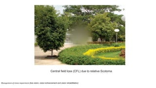 Central field loss (CFL) due to relative Scotoma
Management of vision impairment (low vision, vision enhancement and vision rehabilitation)
 