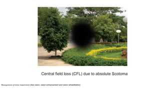Central field loss (CFL) due to absolute Scotoma
Management of vision impairment (low vision, vision enhancement and vision rehabilitation)
 