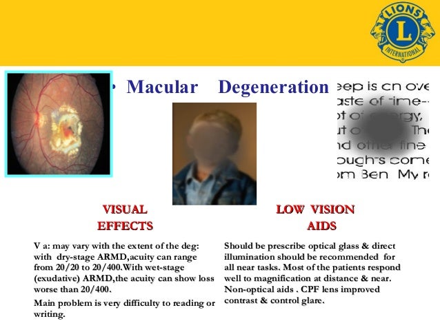 Macular degeneration essay 07 picture