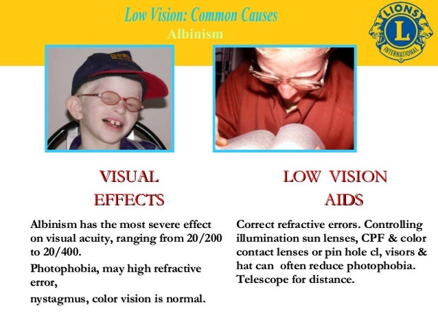 albinism-as-related-to-decreased-vision-blindness-pictures