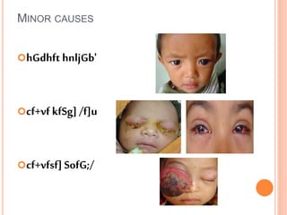 hGdhft hnljGb'
cf+vf kfSg] /f]u
cf+vfsf] SofG;/
MINOR CAUSES
 
