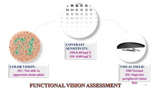 10
COLOR VISION:
OU: Not able to
appreciate demo plate
CONTRAST
SENSITIVITY:
OD:0.48 logCS
OS: 0.00 logCS
VISUAL FIELD:
OD:Normal
OS: Superior
peripheral vision
loss
 