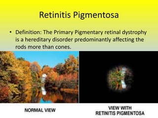 Low vision case Study Of Retintis Pigmentosa | PPTX