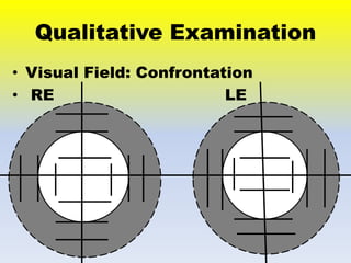 Low vision case Study Of Retintis Pigmentosa | PPTX