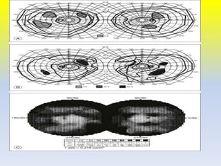 Low vision case Study Of Retintis Pigmentosa | PPTX