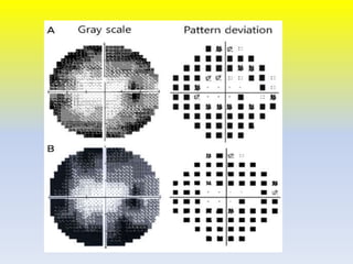 Low vision case Study Of Retintis Pigmentosa | PPTX