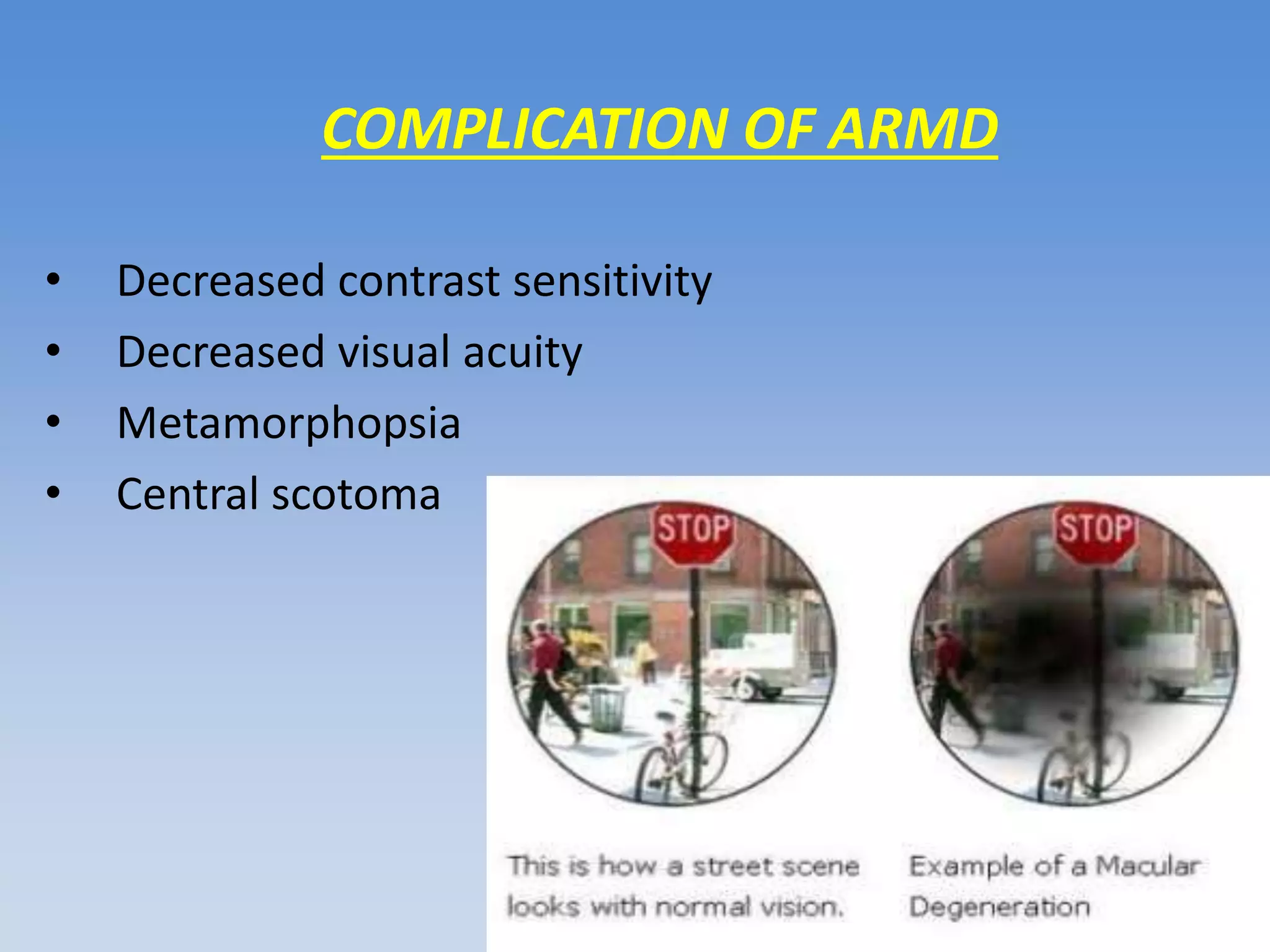 Decreases Visual Sign Low vision workup in ARMD | PPTX | Eye and Vision Conditions | Diseases ...