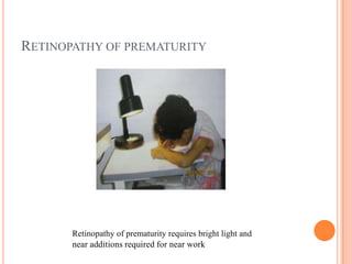RETINOPATHY OF PREMATURITY
Retinopathy of prematurity requires bright light and
near additions required for near work
 
