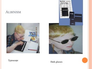 ALBINISM
Typoscope
Dark glasses
 
