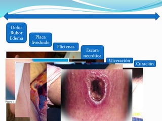 Dolor
Rubor
Edema Placa
livedoide
Flictenas
Escara
necrótica
Ulceración
Curación
 