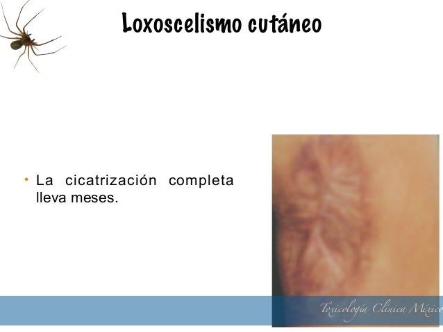 Loxoscelismo