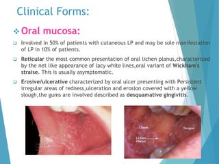 Clinical Forms:
 Oral mucosa:
 Involved in 50% of patients with cutaneous LP and may be sole manifestation
of LP in 10% of patients.
 Reticular the most common presentation of oral lichen planus,characterized
by the net like appearance of lacy white lines,oral variant of Wickham's
straise. This is usually asymptomatic.
 Erosive/ulcerative characterized by oral ulcer presenting with Persistent
irregular areas of redness,ulceration and erosion covered with a yellow
slough,the gums are involved described as desquamative gingivitis.
 