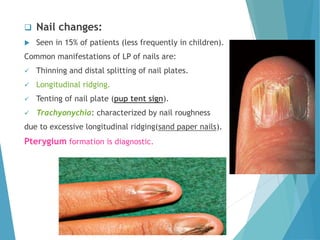  Nail changes:
 Seen in 15% of patients (less frequently in children).
Common manifestations of LP of nails are:
 Thinning and distal splitting of nail plates.
 Longitudinal ridging.
 Tenting of nail plate (pup tent sign).
 Trachyonychia: characterized by nail roughness
due to excessive longitudinal ridging(sand paper nails).
Pterygium formation is diagnostic.
 