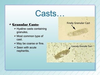 Casts…
Granular Casts-
  Hyaline casts containing
  granules.
  Most common type of
  cast.
  May be coarse or fine.
  Seen with acute
  nepheritis.
 