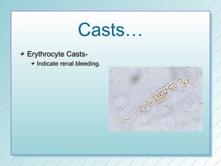 Casts…
Erythrocyte Casts-
  Indicate renal bleeding.
 