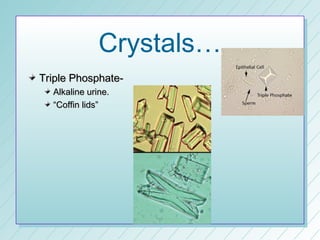 Crystals…
Triple Phosphate-
  Alkaline urine.
  “Coffin lids”
 