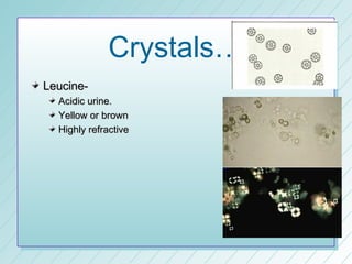 Crystals…
Leucine-
  Acidic urine.
  Yellow or brown
  Highly refractive
 
