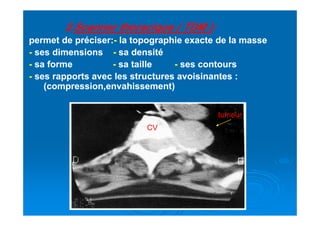 22..Scanner thoracique ( TDM )Scanner thoracique ( TDM ):
permet de préciser:permet de préciser:-- la topographie exacte de la massela topographie exacte de la masse
-- ses dimensionsses dimensions -- sa densitésa densité
-- sa formesa forme -- sa taillesa taille -- ses contoursses contours
-- ses rapports avec les structures avoisinantes :ses rapports avec les structures avoisinantes :
(compression,envahissement)(compression,envahissement)
tumeur
CV
tumeur
 