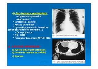 b)b) les tumeurs germinales:les tumeurs germinales:
-- origine embryonnaire.origine embryonnaire.
-- regroupent :regroupent :
* tératomes ( bénins)* tératomes ( bénins)
* kystes dermoides* kystes dermoides
* dysembryome malin immature* dysembryome malin immature
(choriocarcinome,séminome…)(choriocarcinome,séminome…)
-- Dc repose sur :Dc repose sur :
* RX , TDM ,* RX , TDM ,* RX , TDM ,* RX , TDM ,
* marqueur tumoraux(AFP,BHCG)* marqueur tumoraux(AFP,BHCG)
A .A .33 ETAGE INFERIEUR:ETAGE INFERIEUR:
a) kystes pleuro péricardiques.a) kystes pleuro péricardiques.
b) hernie de la fente de LARREb) hernie de la fente de LARRE
c) lipomesc) lipomes
 