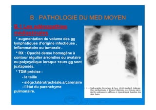 B . PATHOLOGIE DU MED MOYENB . PATHOLOGIE DU MED MOYEN
B.B.11 Les adénopathiesLes adénopathies
médiastinalesmédiastinales
* augmentation du volume des gg* augmentation du volume des gg
lymphatiques d’origine infectieuse ,lymphatiques d’origine infectieuse ,
inflammatoire ou tumorale .inflammatoire ou tumorale .
* RX : Opacité dense homogène à* RX : Opacité dense homogène à* RX : Opacité dense homogène à* RX : Opacité dense homogène à
contour régulier arrondies ou ovalairecontour régulier arrondies ou ovalaire
ou polycyclique lorsque +eurs gg sontou polycyclique lorsque +eurs gg sont
juxtaposés.juxtaposés.
* TDM* TDM précise :précise :
-- la taillela taille
-- siége:latérotrachéale,s/carènairesiége:latérotrachéale,s/carènaire
-- l’état du parenchymel’état du parenchyme
pulmonaire.pulmonaire.
 