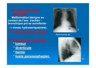B.B.22 kyste bronchokyste broncho
génique:génique:
Malformation bénigne auMalformation bénigne au
contact de l’axe trachéocontact de l’axe trachéo --
bronchique pvt se surinfecterbronchique pvt se surinfecter
→→→→→→→→ niveau hydroaerique(rare).niveau hydroaerique(rare).
B.B.33 Anévrysme aortique.Anévrysme aortique.
Anévrysme ao
F
B.B.44 Pathologie oesophag:Pathologie oesophag:
** tumeurtumeur
** diverticulediverticule
** herniehernie
** kyste paraosophagien.kyste paraosophagien.
Anévrysme ao
P
 