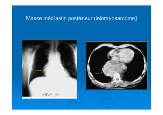 Masse médiastin postérieur (leiomyosarcome)Masse médiastin postérieur (leiomyosarcome)
 