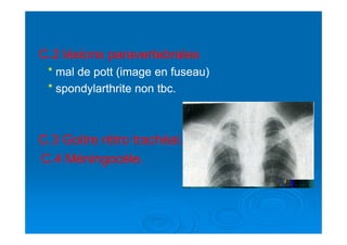 C.C.22 lésions paravertebraleslésions paravertebrales
** mal de pott (image en fuseau)mal de pott (image en fuseau)
** spondylarthrite non tbc.spondylarthrite non tbc.
C.C.33 Goitre rétro trachéal.Goitre rétro trachéal.
C.C.44 Méningocèle.Méningocèle.
 