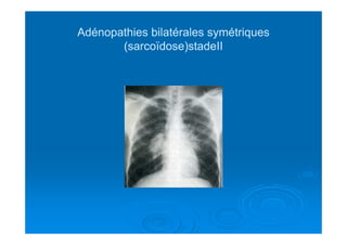 Adénopathies bilatérales symétriquesAdénopathies bilatérales symétriques
(sarcoïdose)stadeII(sarcoïdose)stadeII
 