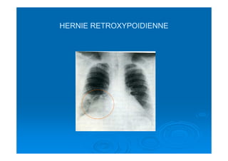 HERNIE RETROXYPOIDIENNEHERNIE RETROXYPOIDIENNE
 