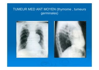 TUMEUR MED ANT MOYEN (thymome , tumeursTUMEUR MED ANT MOYEN (thymome , tumeurs
germinales)germinales)
 