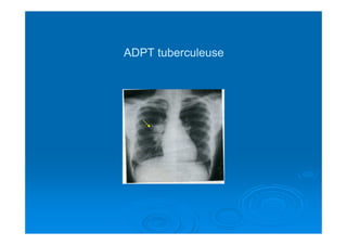 ADPT tuberculeuseADPT tuberculeuse
 