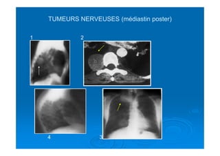 TUMEURS NERVEUSES (médiastin poster)TUMEURS NERVEUSES (médiastin poster)
1 2
34
 
