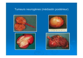 Tumeurs neurogènes (médiastin postérieur)Tumeurs neurogènes (médiastin postérieur)
 