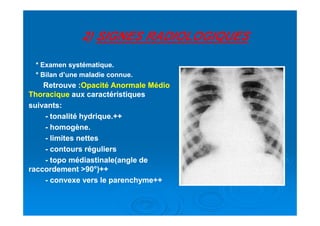 22)) SIGNES RADIOLOGIQUESSIGNES RADIOLOGIQUES
* Examen systématique.* Examen systématique.
* Bilan d’une maladie connue.* Bilan d’une maladie connue.
Retrouve :Retrouve :Opacité Anormale MédioOpacité Anormale Médio
ThoraciqueThoracique aux caractéristiquesaux caractéristiques
suivants:suivants:
-- tonalité hydrique.++tonalité hydrique.++-- tonalité hydrique.++tonalité hydrique.++
-- homogène.homogène.
-- limites netteslimites nettes
-- contours régulierscontours réguliers
-- topo médiastinale(angle detopo médiastinale(angle de
raccordement >raccordement >9090°°)++)++
-- convexe vers le parenchyme++convexe vers le parenchyme++
 