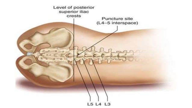Lumbar puncture and CSF Analysis | PPTX