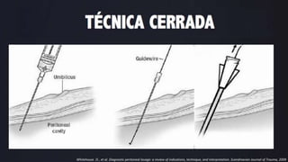 TÉCNICA SEMI -ABIERTA
Whitehouse JS , et al. Diagnostic peritoneal lavage: a review of indications, technique, and interpretation. Scandinavian Journal of Trauma, 2009
 