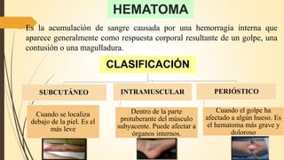HEMATOMA
Es la acumulación de sangre causada por una hemorragia interna que
aparece generalmente como respuesta corporal resultante de un golpe, una
contusión o una magulladura.
CLASIFICACIÓN
SUBCUTÁNEO
Cuando se localiza
debajo de la piel. Es el
más leve
INTRAMUSCULAR
Dentro de la parte
protuberante del músculo
subyacente. Puede afectar a
órganos internos.
PERIÓSTICO
Cuando el golpe ha
afectado a algún hueso. Es
el hematoma más grave y
doloroso
 