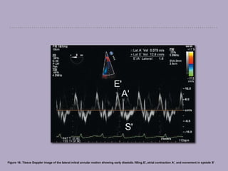 Figure 16: Tissue Doppler image of the lateral mitral annular motion showing early diastolic filling E', atrial contraction A', and movement in systole S'
 