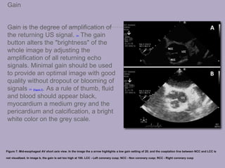 Gain
Gain is the degree of amplification of
the returning US signal. [20] The gain
button alters the "brightness" of the
whole image by adjusting the
amplification of all returning echo
signals. Minimal gain should be used
to provide an optimal image with good
quality without dropout or blooming of
signals [14] [Figure 7]. As a rule of thumb, fluid
and blood should appear black,
myocardium a medium grey and the
pericardium and calcification, a bright
white color on the grey scale.
Figure 7: Mid-esophageal AV short axis view. In the image the a arrow highlights a low gain setting of 20; and the coaptation line between NCC and LCC is
not visualized. In image b, the gain is set too high at 100. LCC - Left coronary cusp; NCC - Non coronary cusp; RCC - Right coronary cusp
 